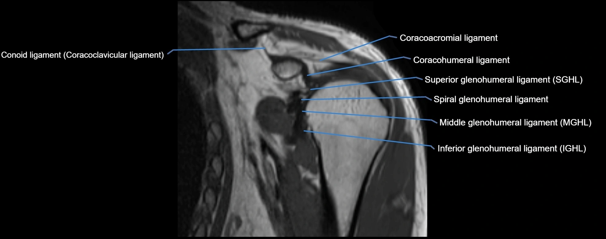 shoulder ligments coronal  cross sectional anatomy 3T MRI AI enhanced radiology image -img-00001-00015.webp